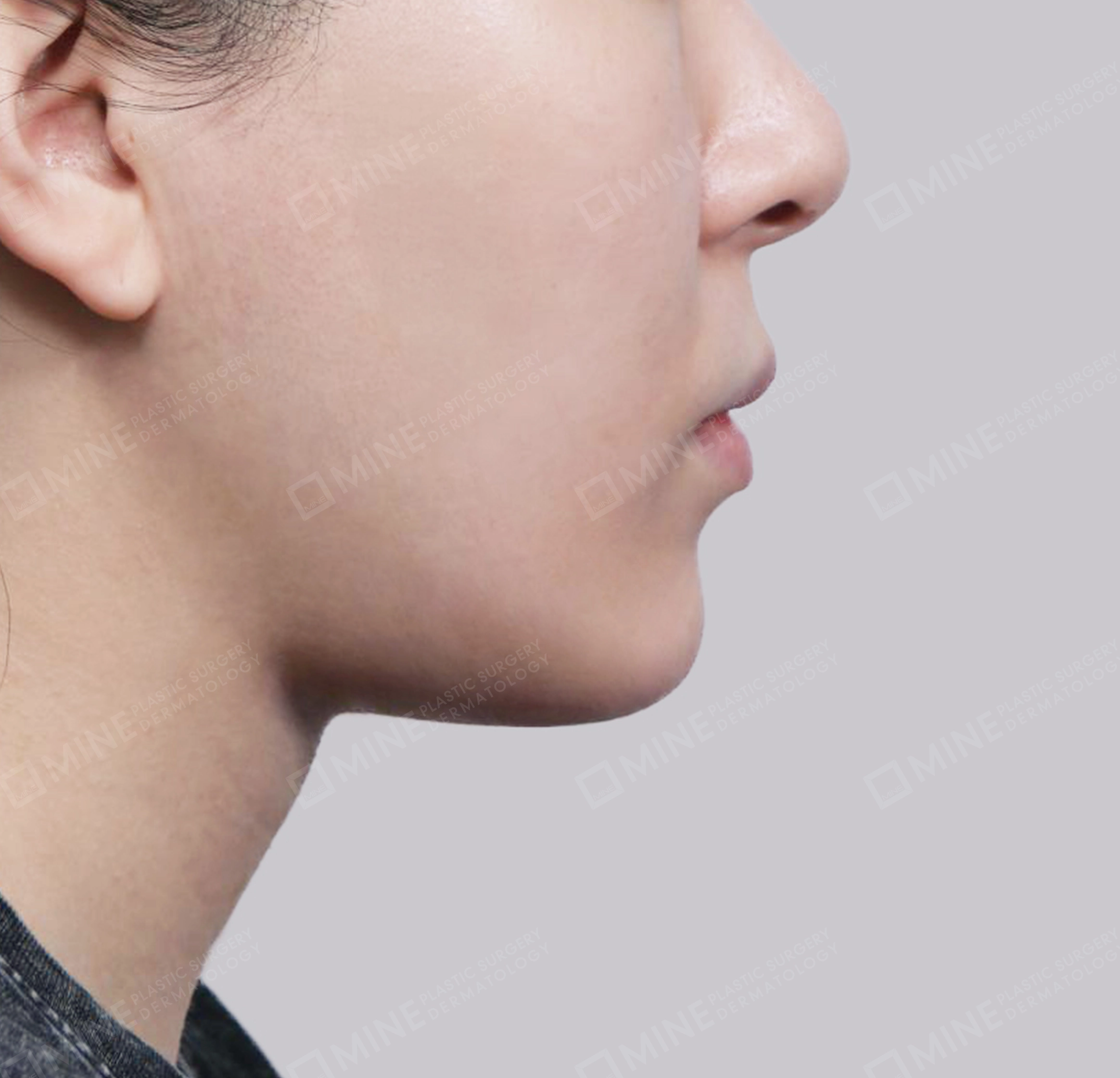 이중턱 근육묶기 + 근육하 지방제거-측면-후