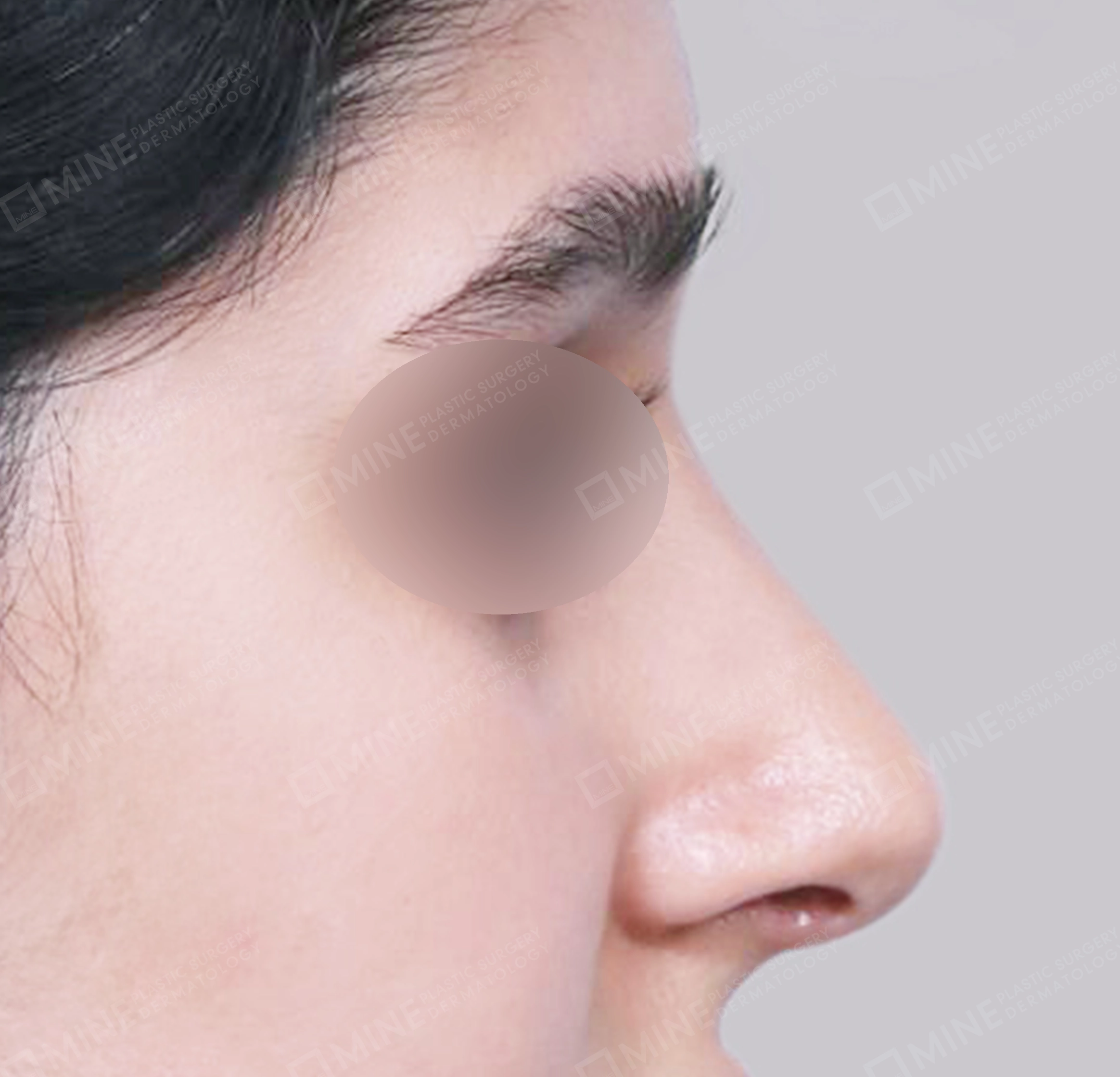 매부리코-측면-후