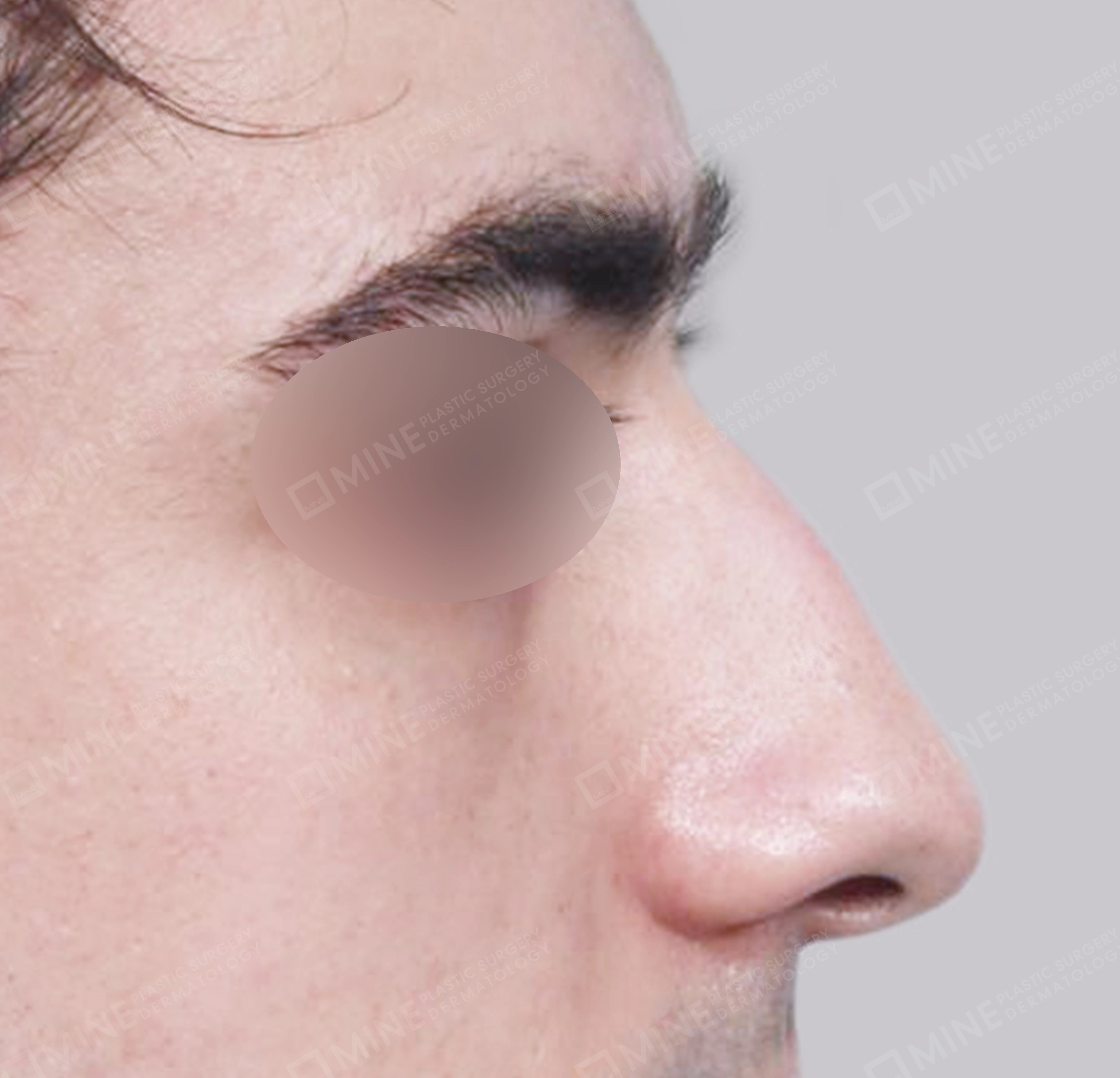 매부리코-측면-전