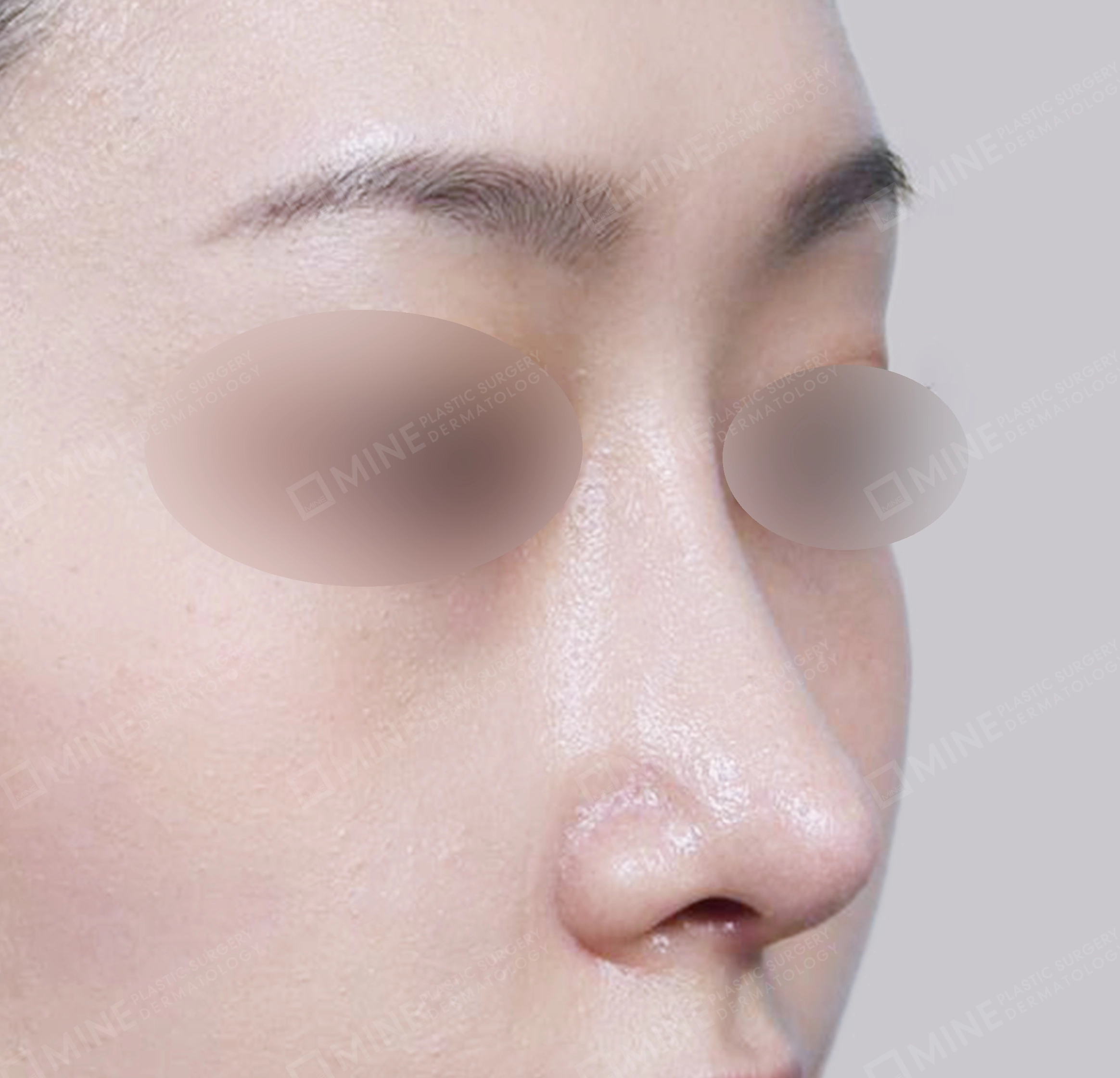 매부리코-전후-후