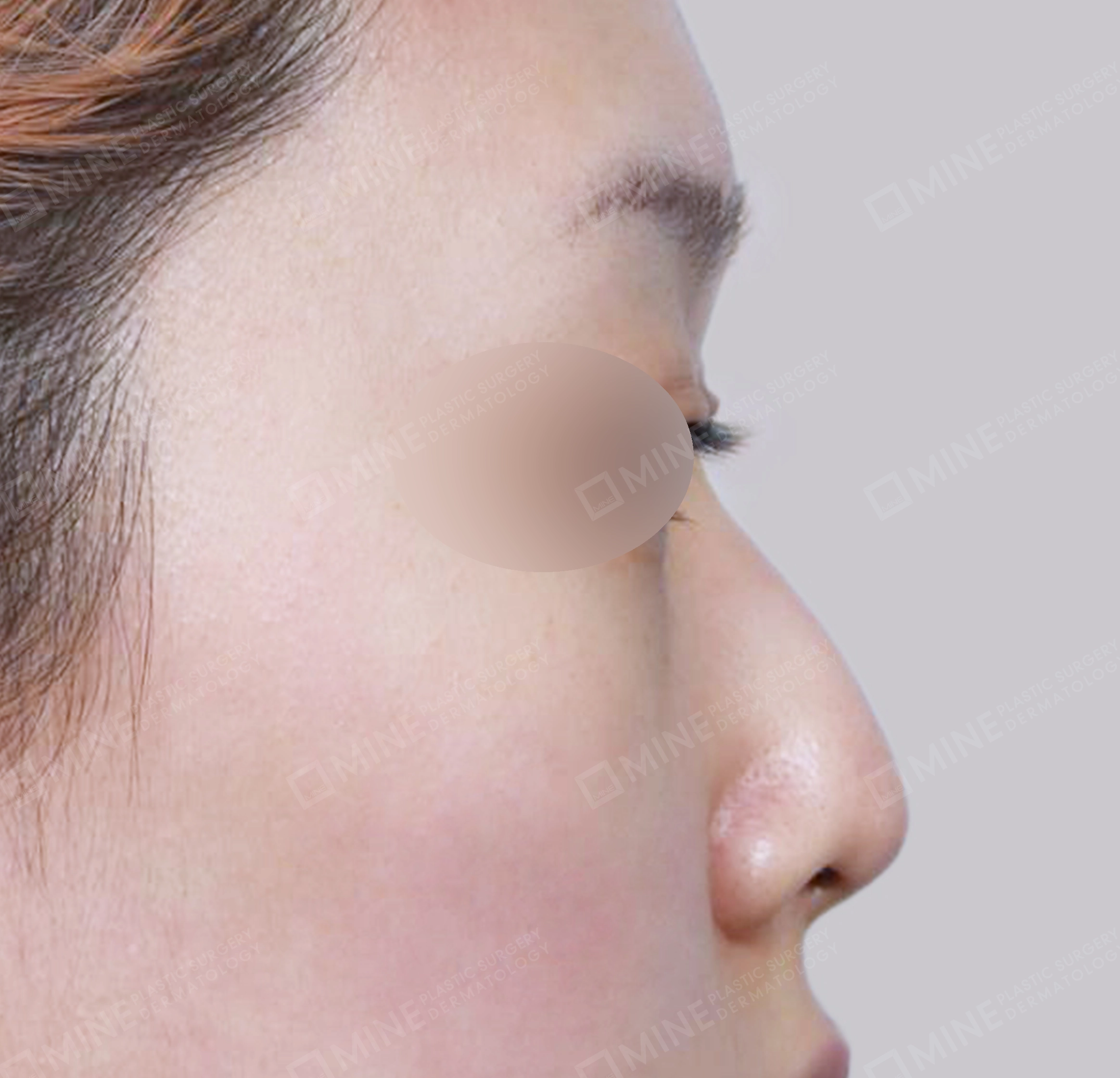 매부리코-측면-전