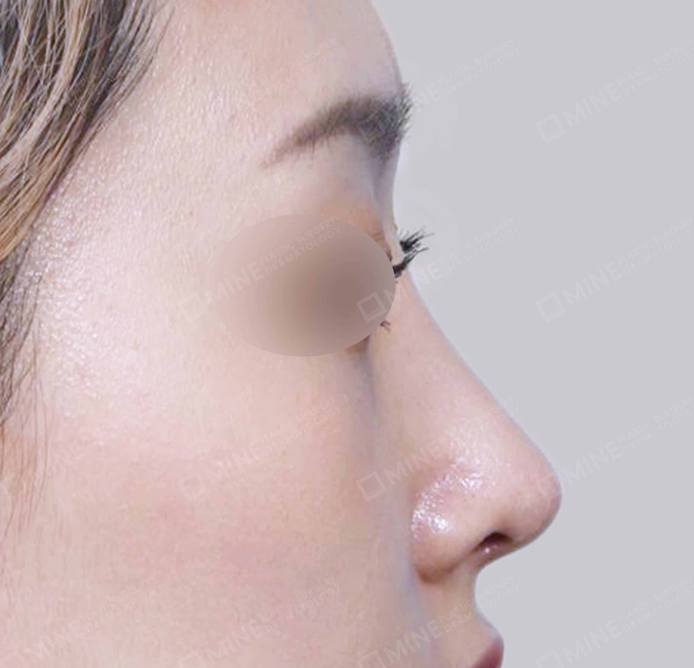 매부리코-측면-후