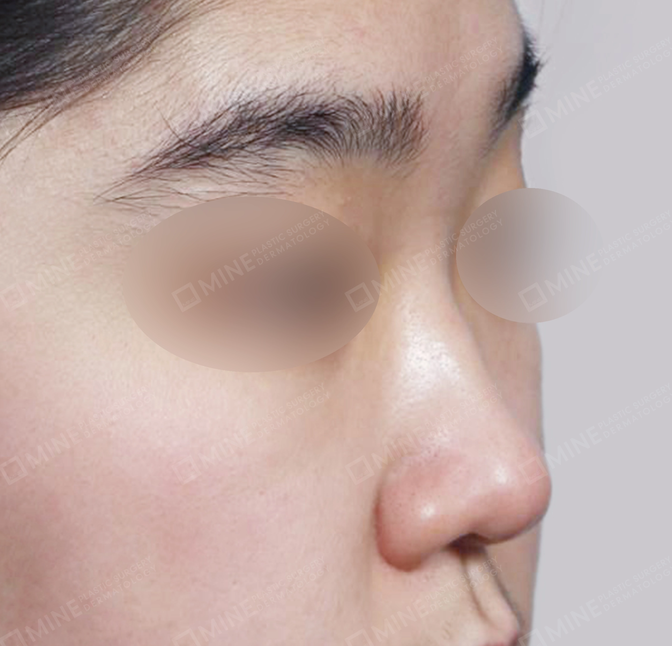 매부리코-전후-전