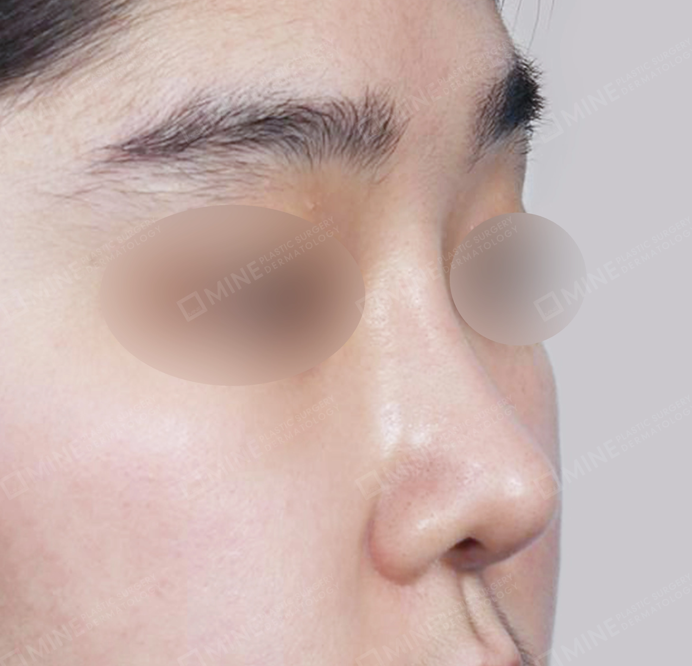 매부리코-전후-후