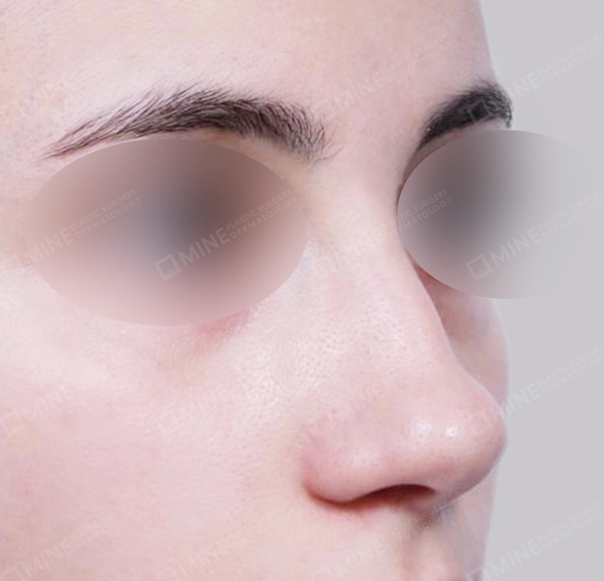 매부리코-전후-전