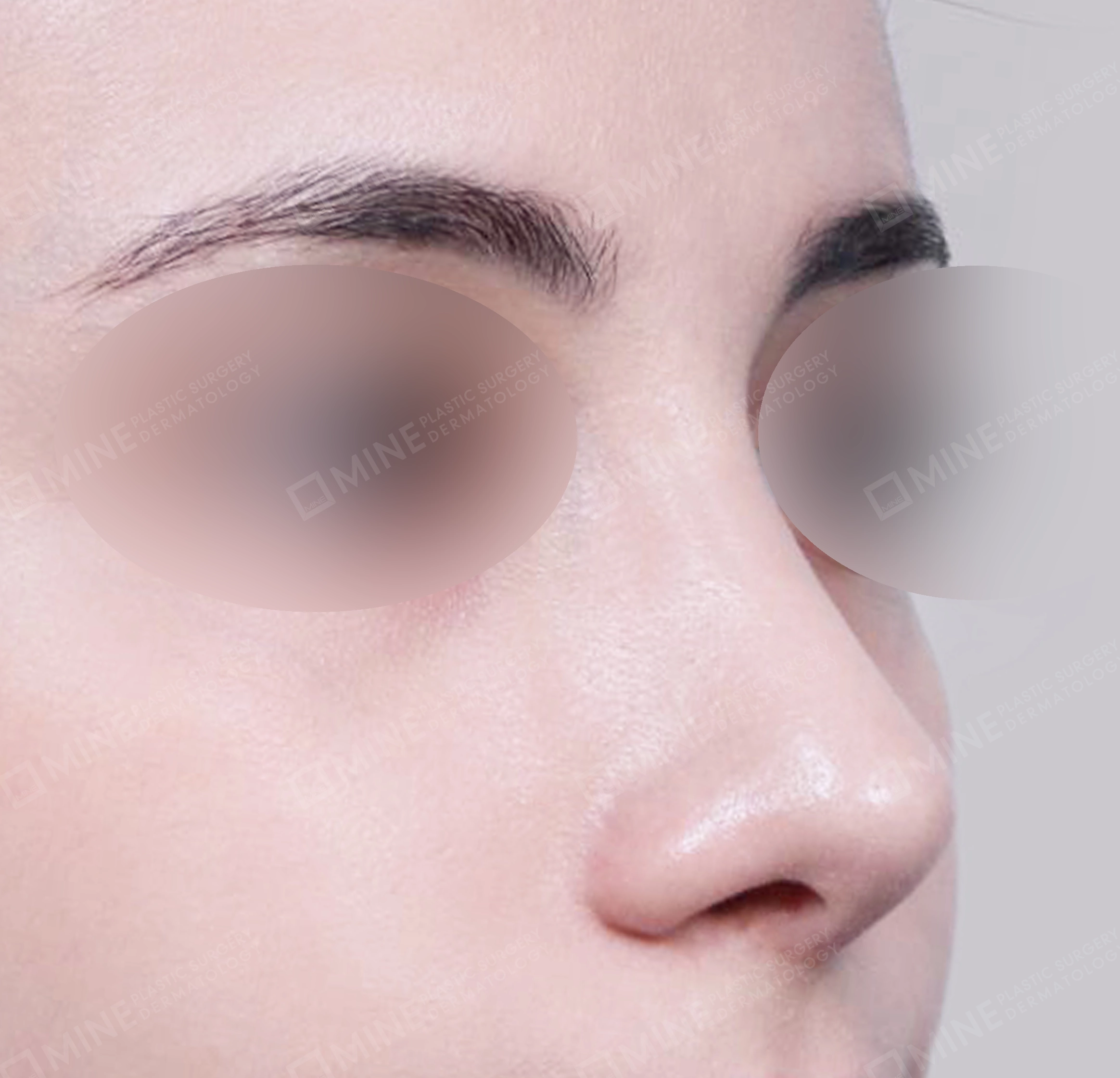 매부리코-전후-후