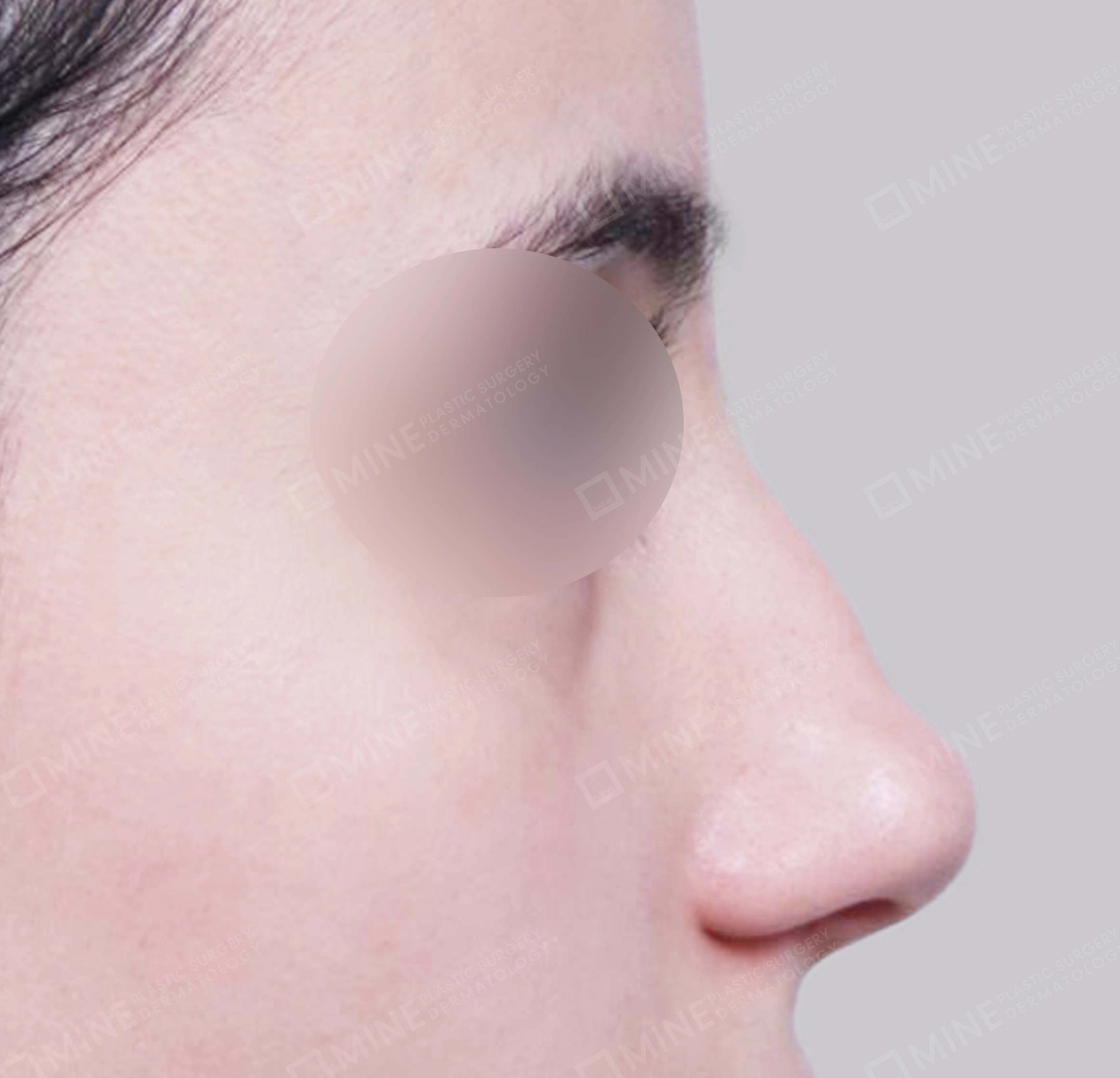 매부리코-측면-전