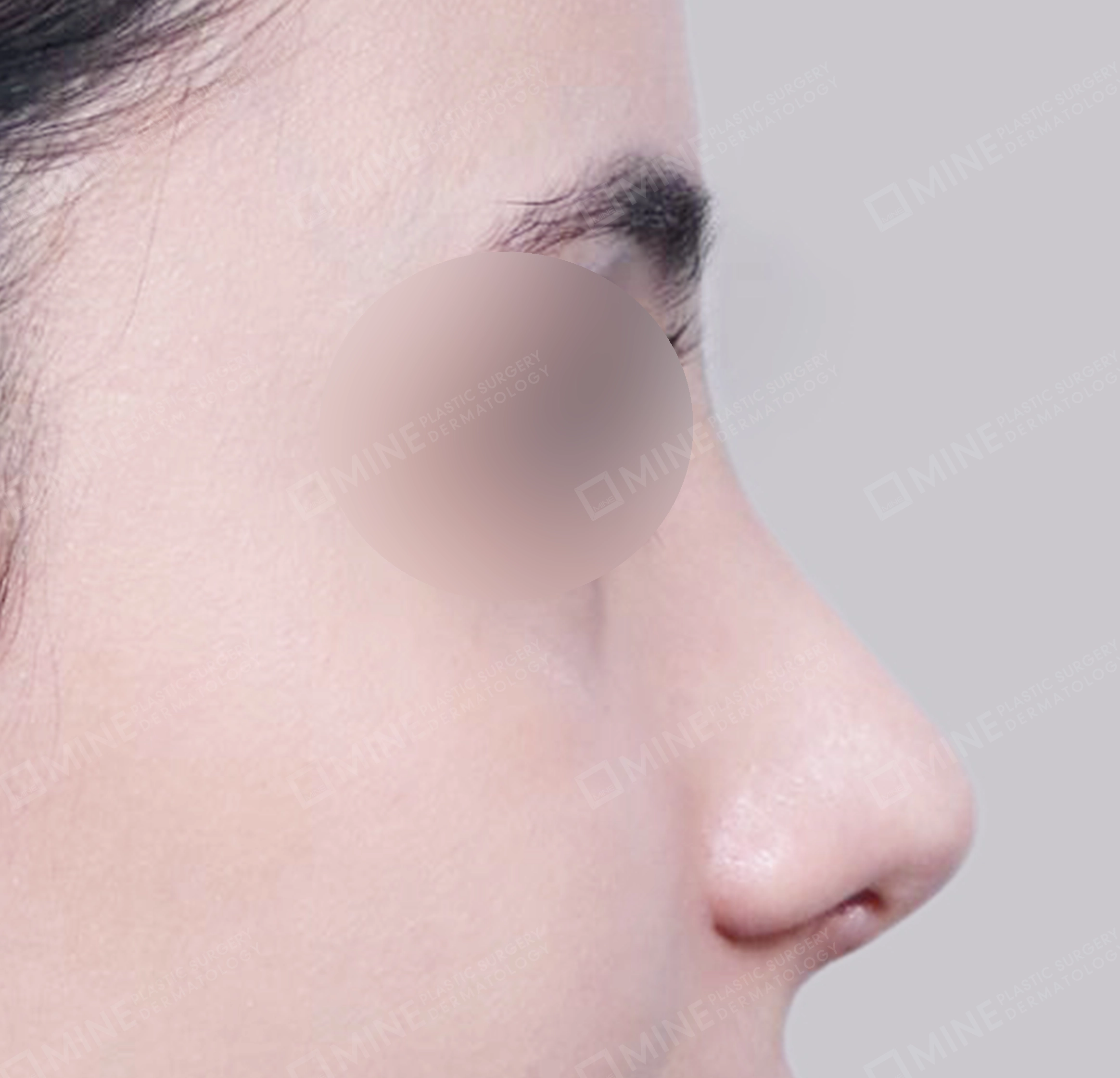 매부리코-측면-후