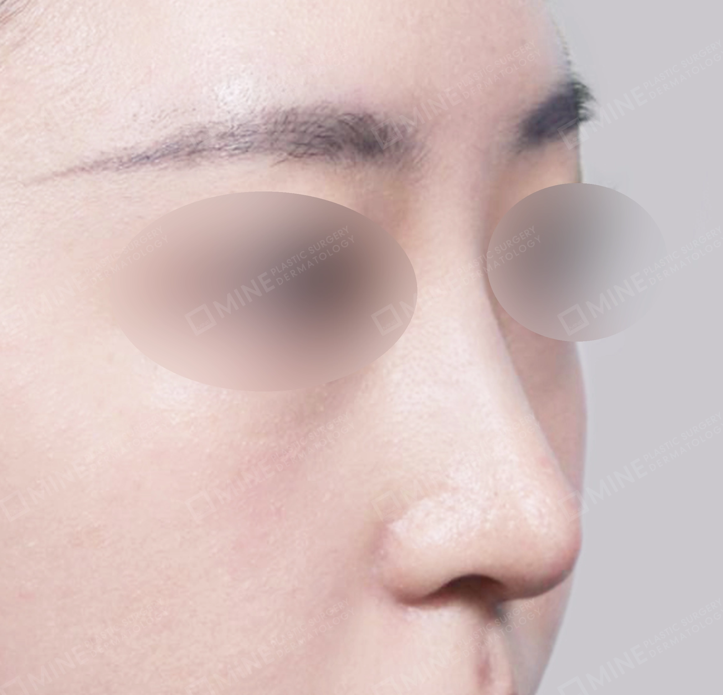 매부리코-전후-후