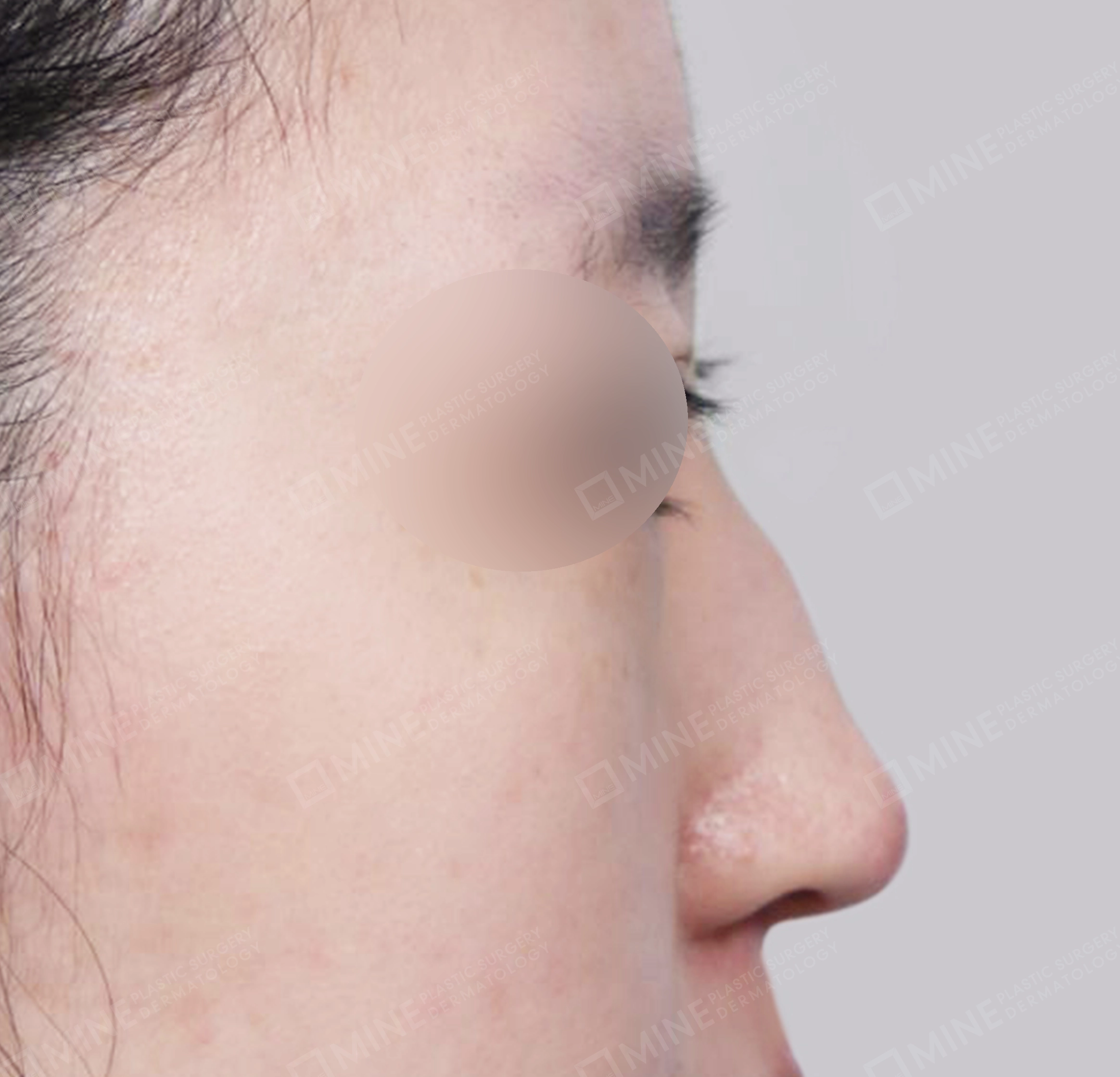 매부리코-측면-전