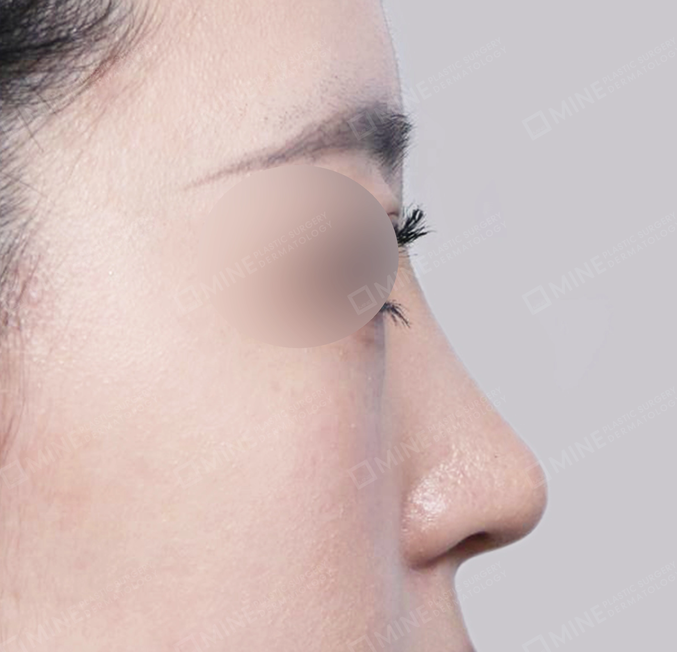 매부리코-측면-후