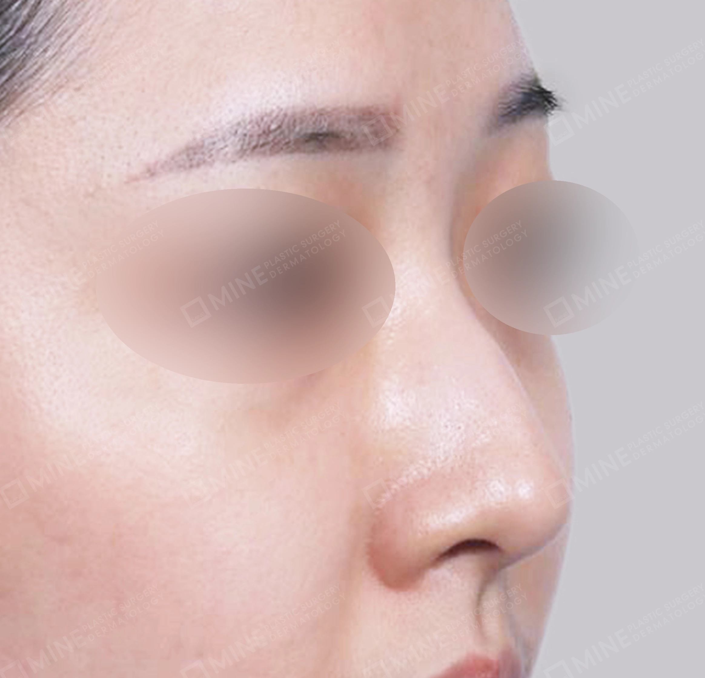 매부리코-전후-전