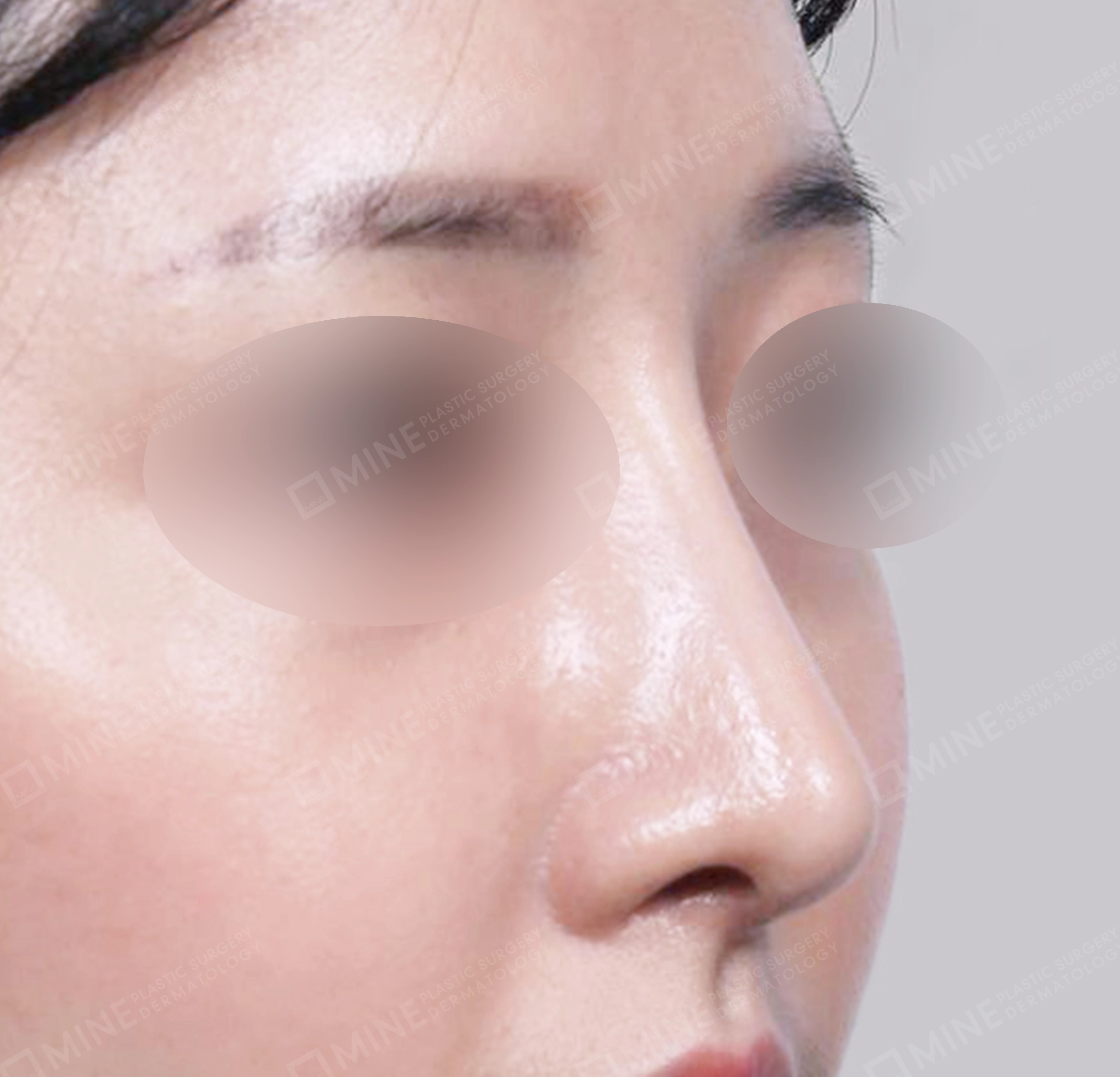 매부리코-전후-후