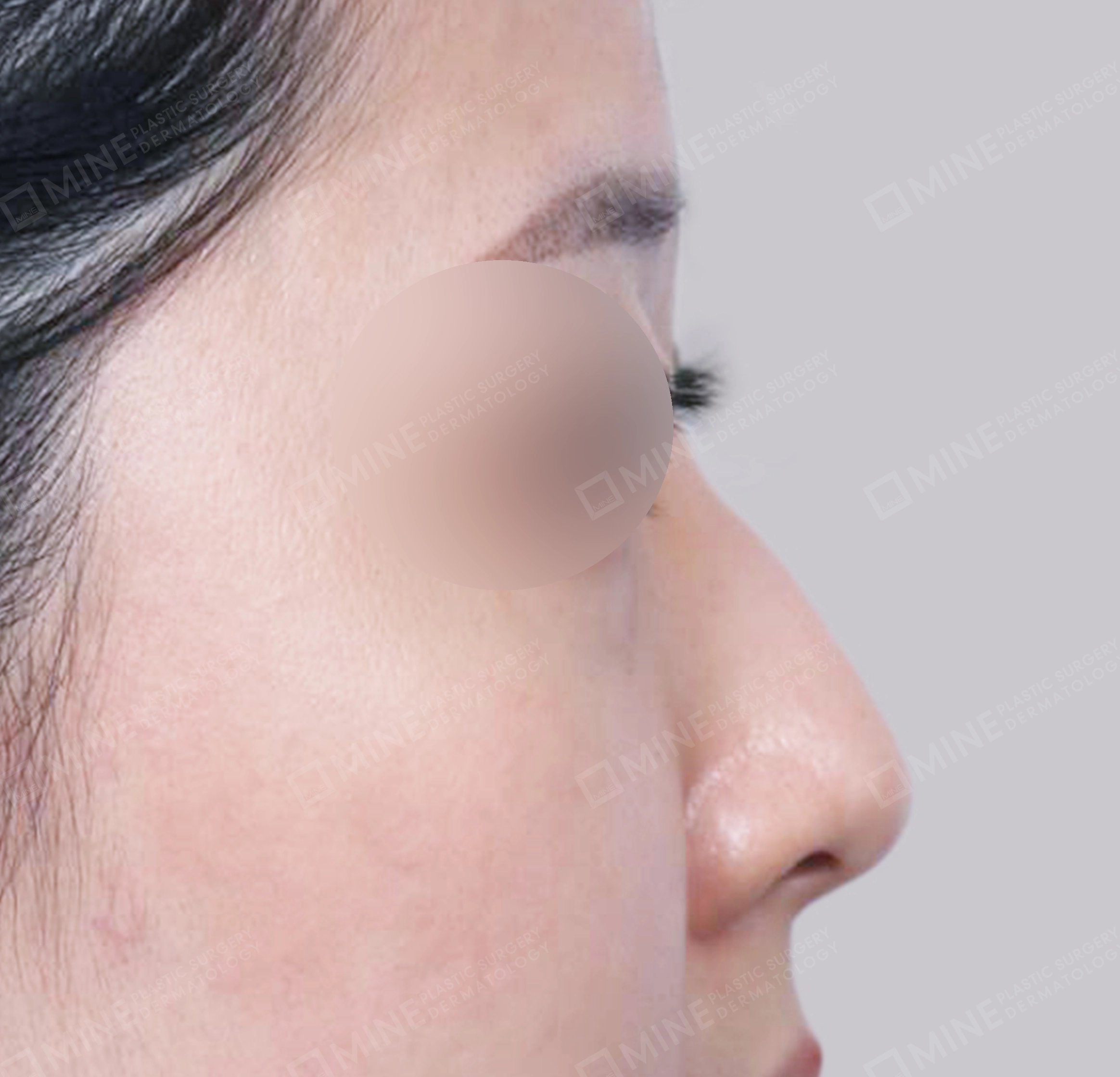 매부리코-측면-전