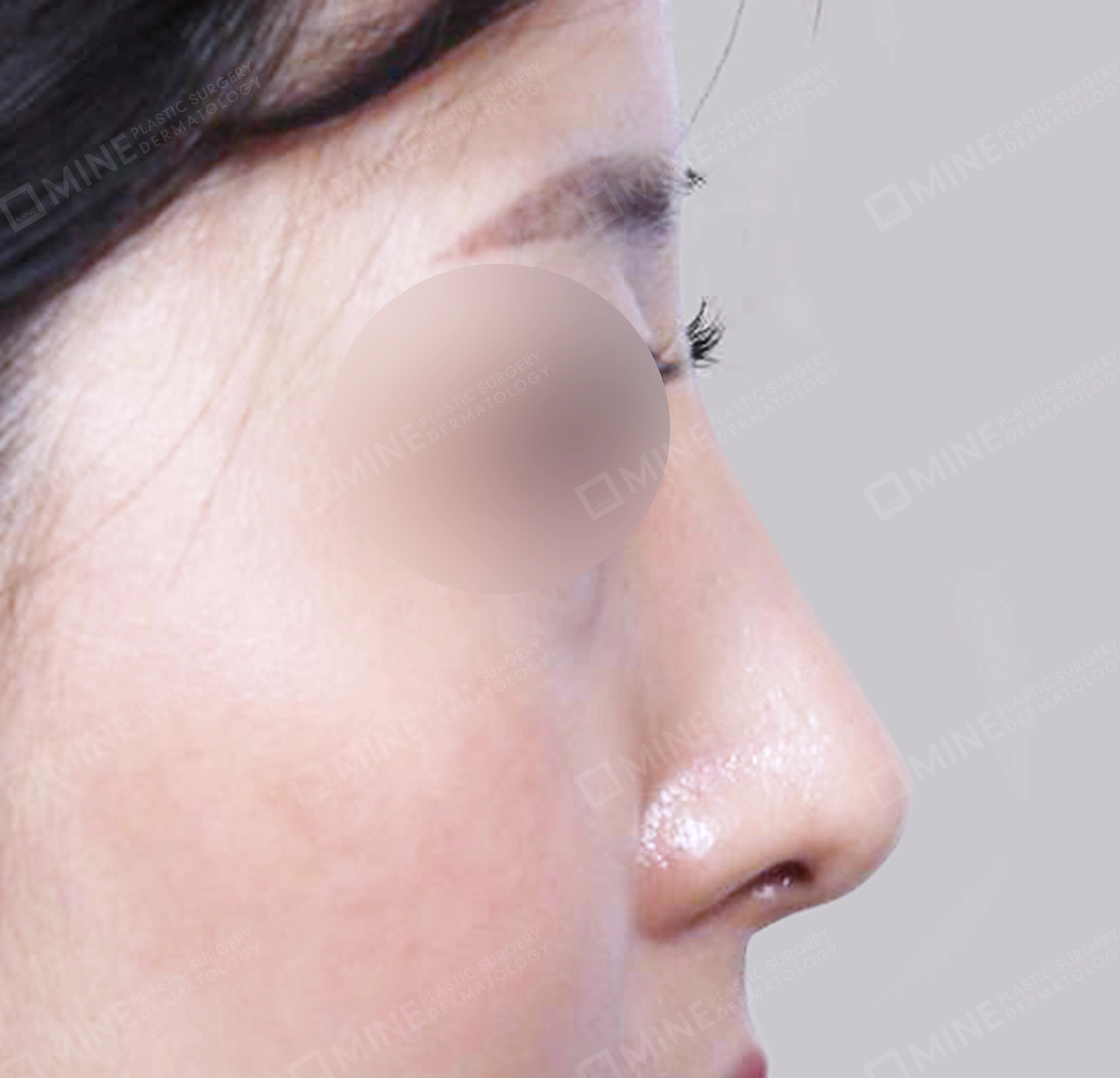 매부리코-측면-후