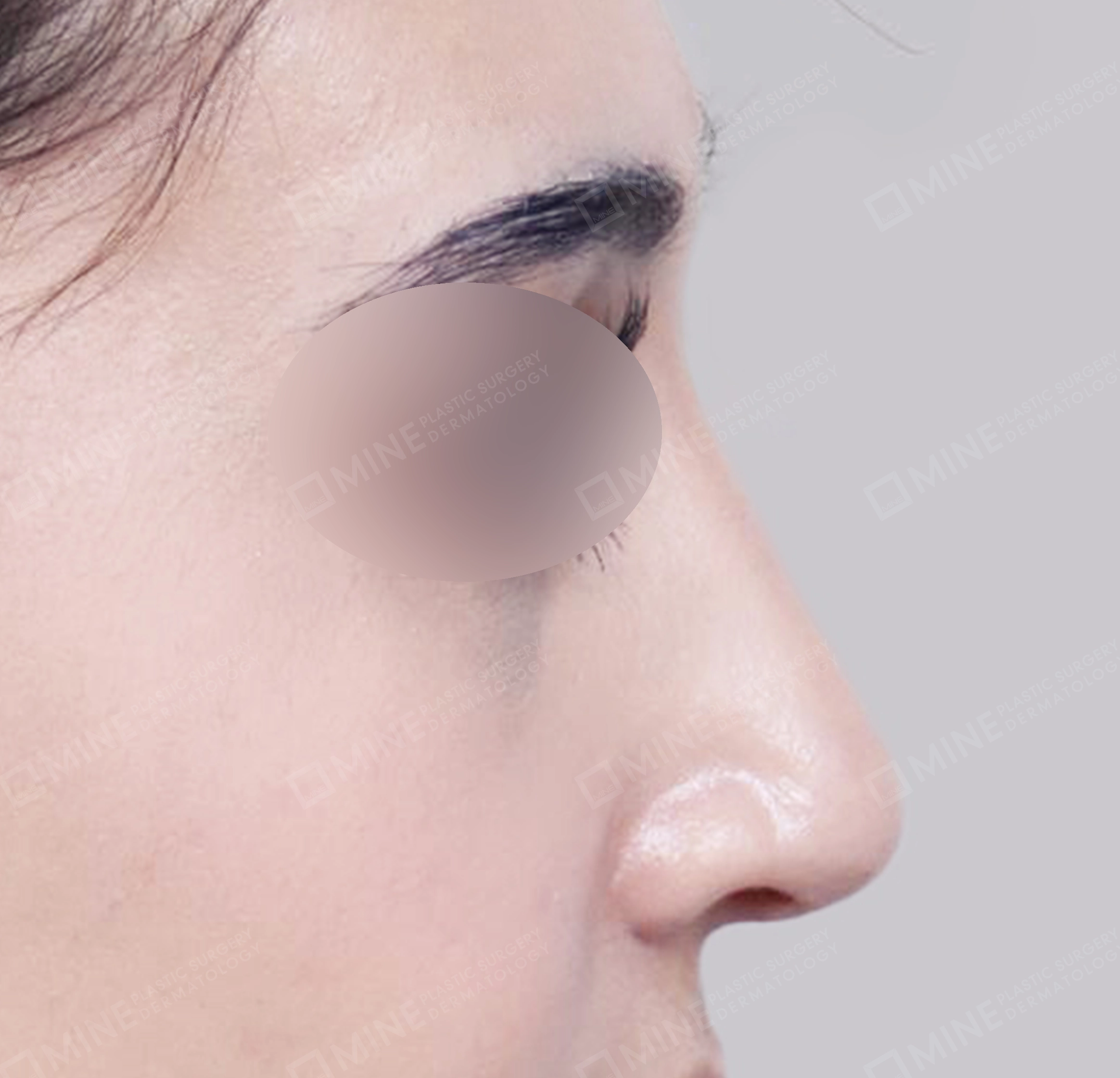 매부리코-측면-후