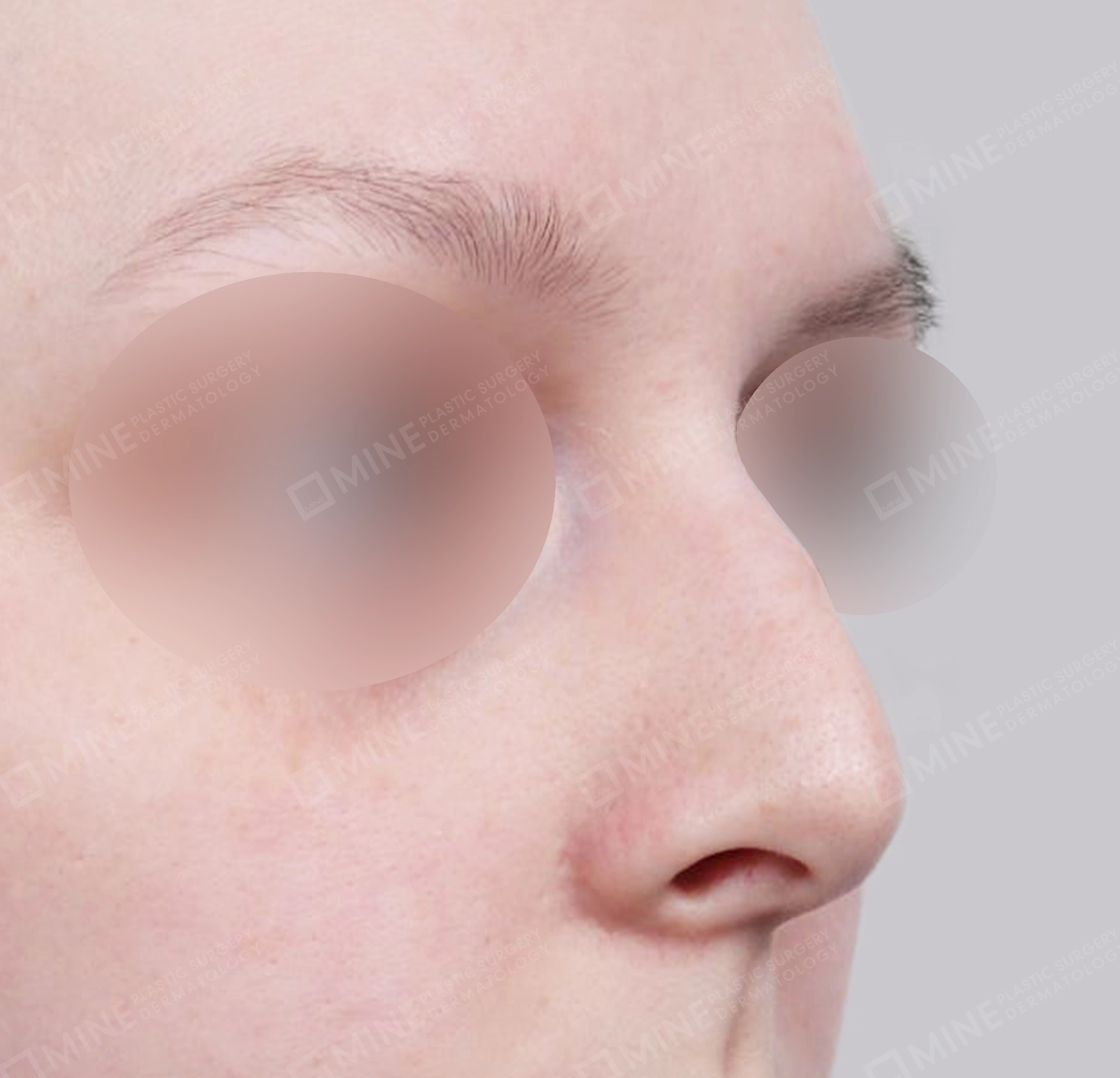 매부리코-전후-전