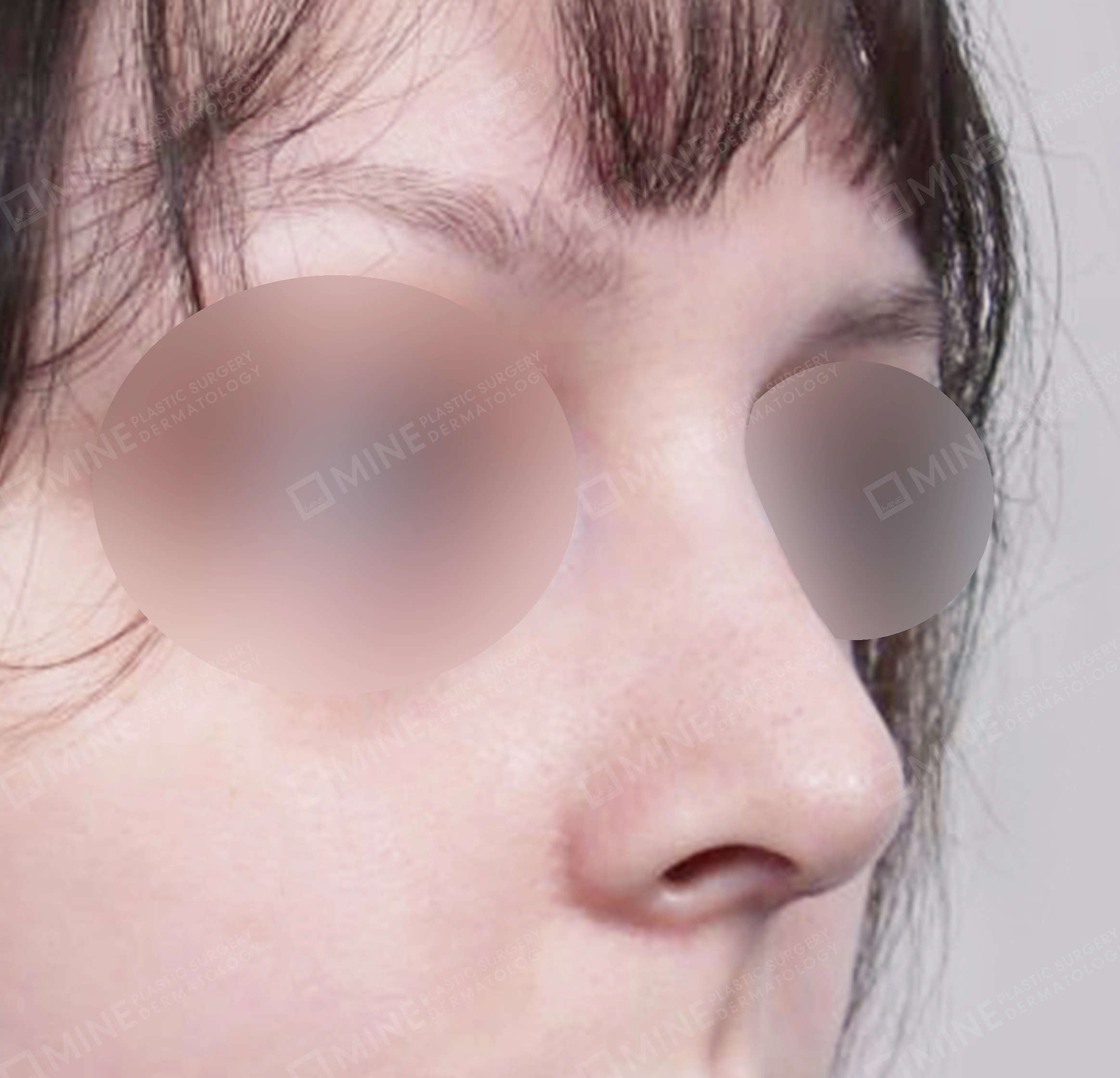 매부리코-전후-후