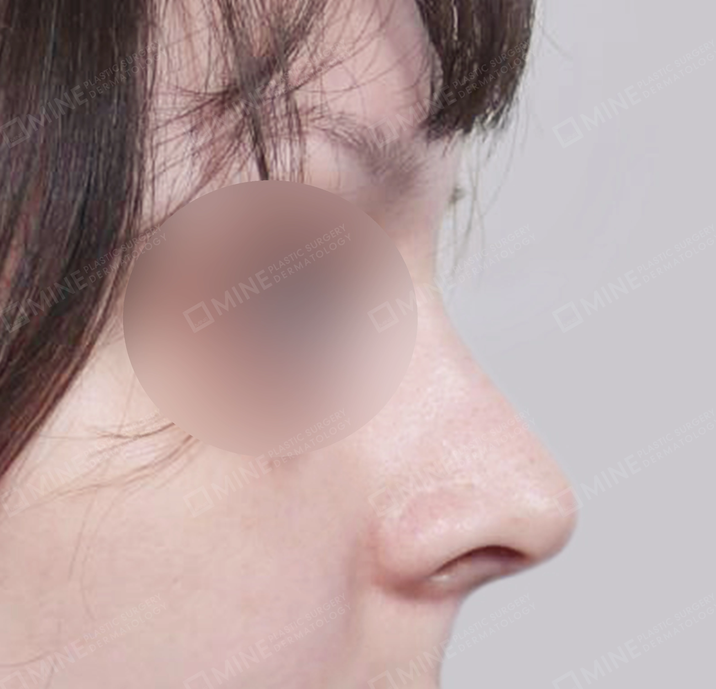 매부리코-측면-후