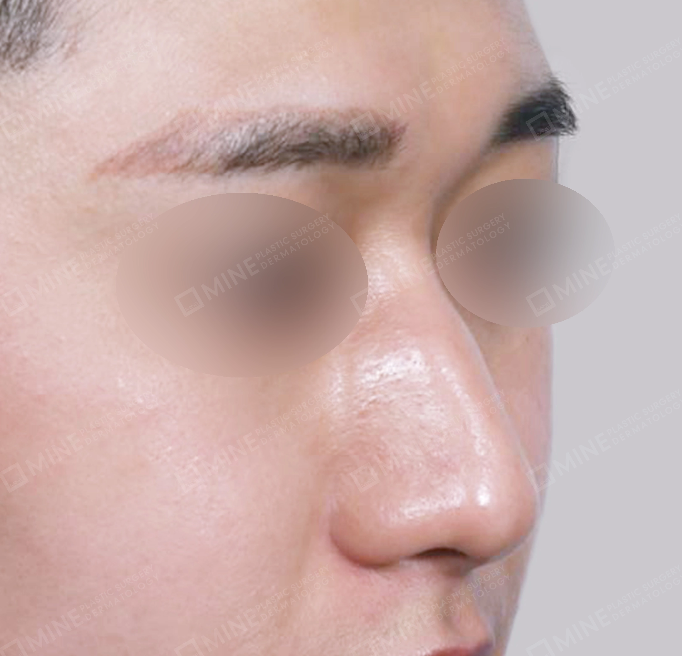 매부리코-전후-전