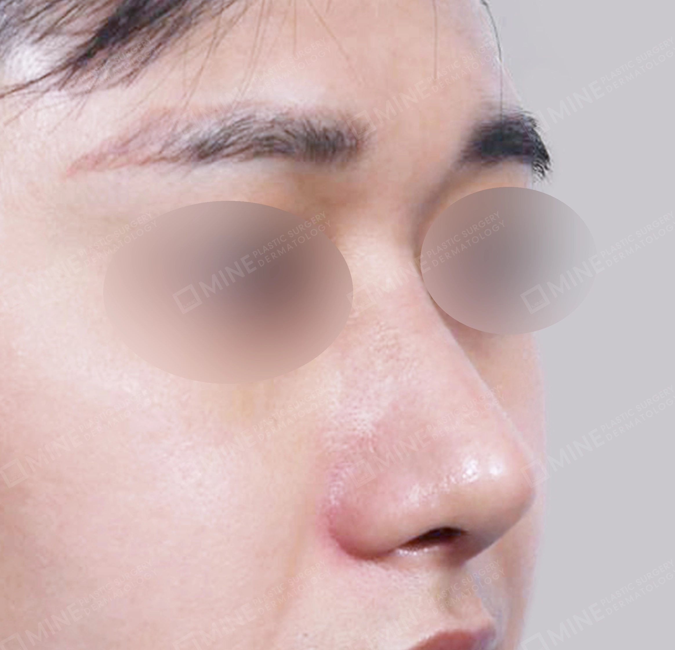 매부리코-전후-후