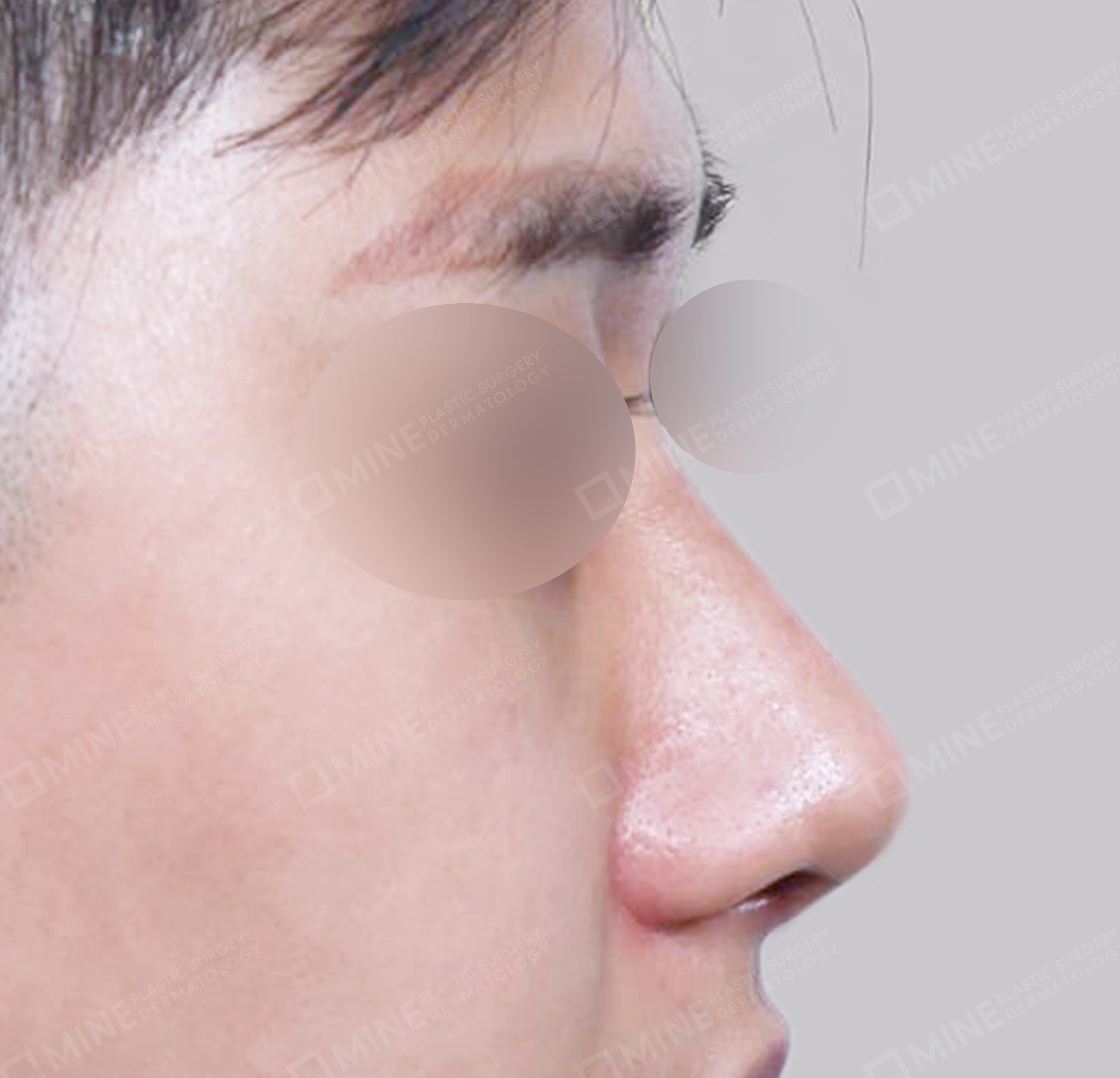 매부리코-측면-후