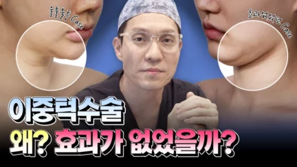 이중턱 재수술을 고민 중인 당신! 필.수.시.청! 1탄😎