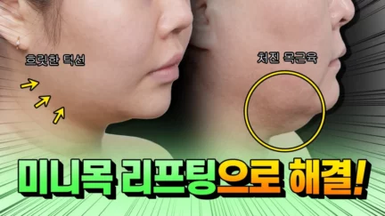 처진 턱살과 턱선리프팅 해주는 수술이 있다구요?｜미니목거상｜턱살리프팅
