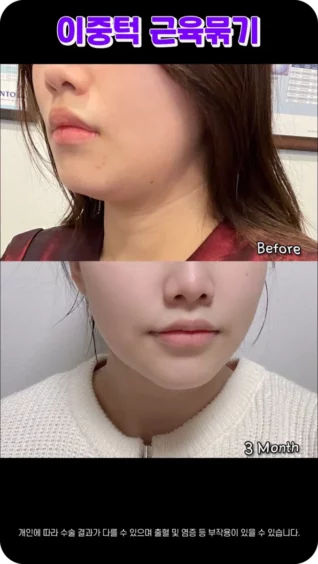[마인 Shorts] 턱살만 정리해도 인상이 달라보여서 기분이 좋아요💖