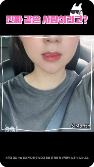 [마인 Shorts] 이중턱 정리만 했는데 이정도? 말도 안돼!