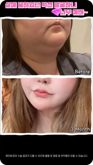 [마인 Shorts] 턱살 볼살 흡입하고 달라진 턱선이 마음에 쏙 들어요✨