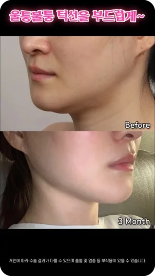 턱밑살 이중턱 확실하게 없애기❣