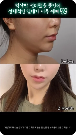 [마인 Shorts] 턱살만 없앴을 뿐인데, 주변에서 너무 예쁘다고 난리예요😎