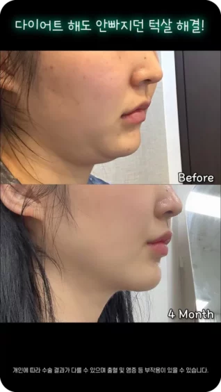 [마인 Shorts] 다이어트 해도 안빠지던 턱살 해결!✨