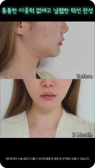 [마인 Shorts] 둥근 턱선의 원인 이중턱, 정리하니 속 시원해요!
