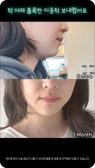 [마인 Shorts] 신경쓰이던 턱 아래 볼록한 살들 안녕~👋