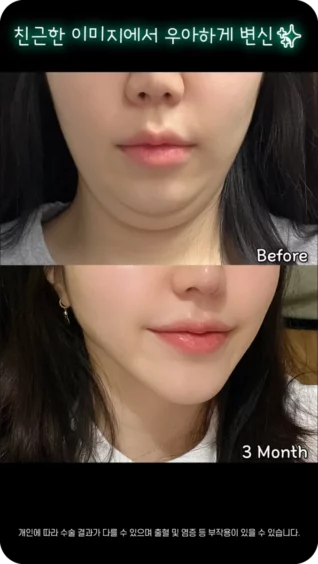 [마인 Shorts] 이미지 변신? 어렵지 않아요! 턱살 정리만으로도 가뿐히 변신✨