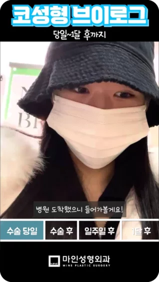 [마인 Shorts] 코성형 수술 직후부터 한달까지👀