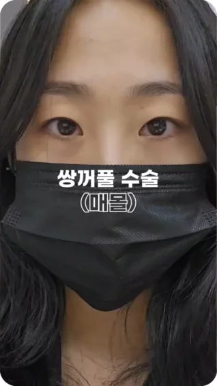 [마인 Shorts] 분위기가 달라보인대요✨! 매몰 쌍수 3개월차 변화