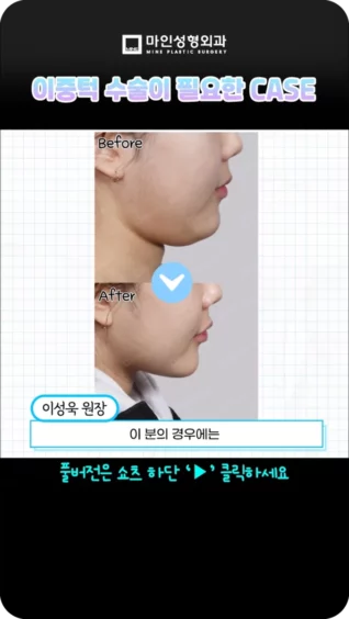 [마인 Shorts] 턱살은 무조건 이중턱 수술?❌아니에요❌이중턱 수술이 필요한 유형이 따로 있어요!!