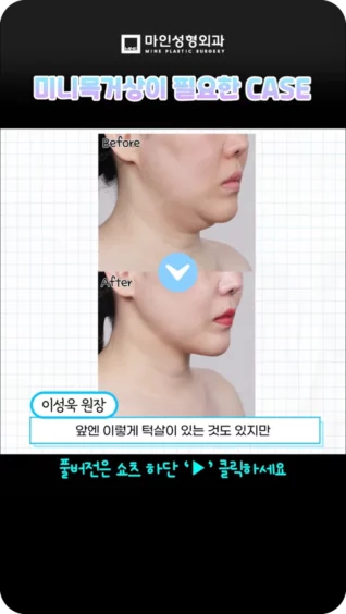 [마인 Shorts] 이중턱 수술로도 안된다고요? 미니목거상으로는 가능!🙆‍♀️